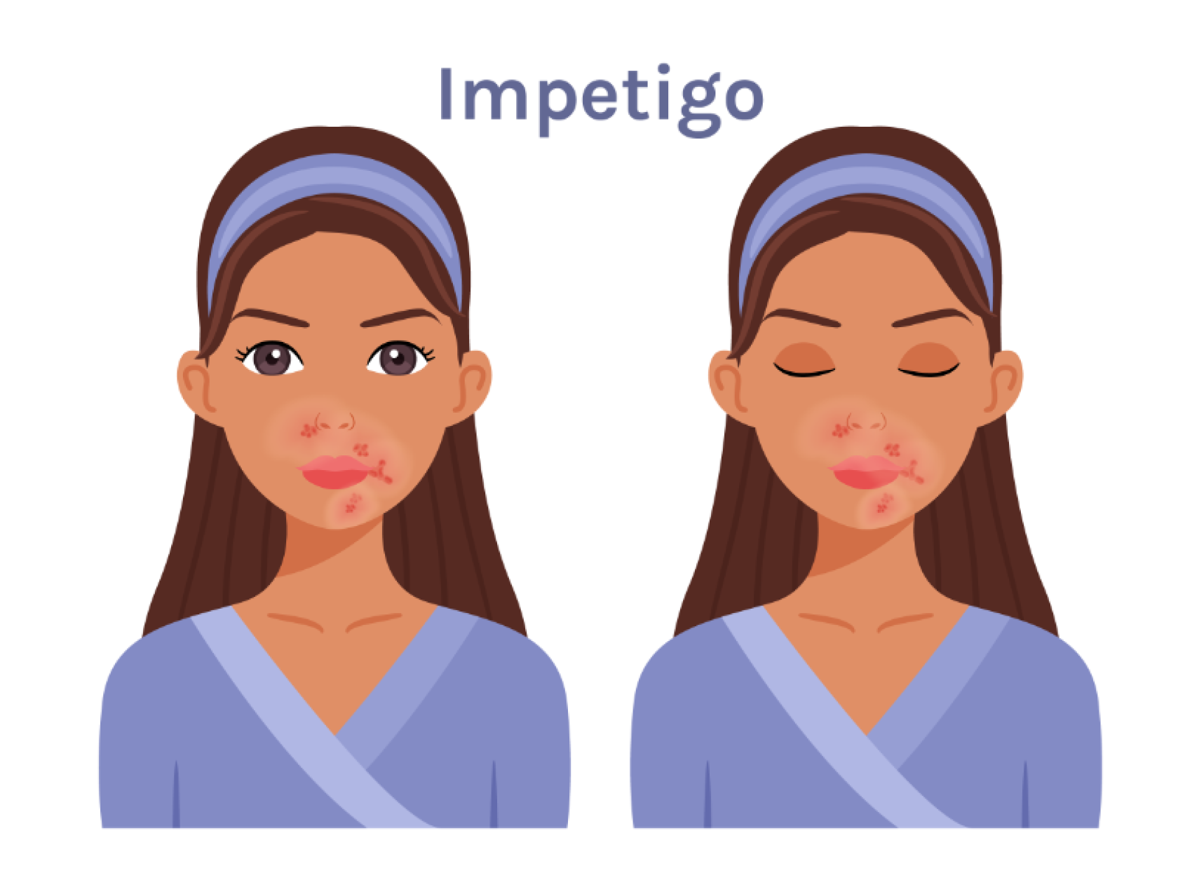 Impetigo: What Does It Look Like, and What Should You Do? | American Camp  Association