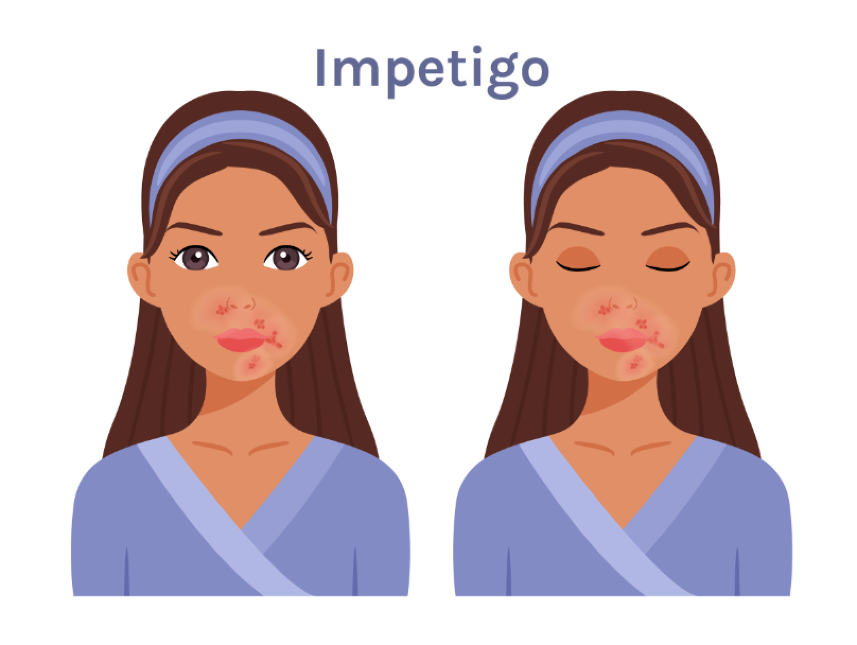 Impetigo Navesurash